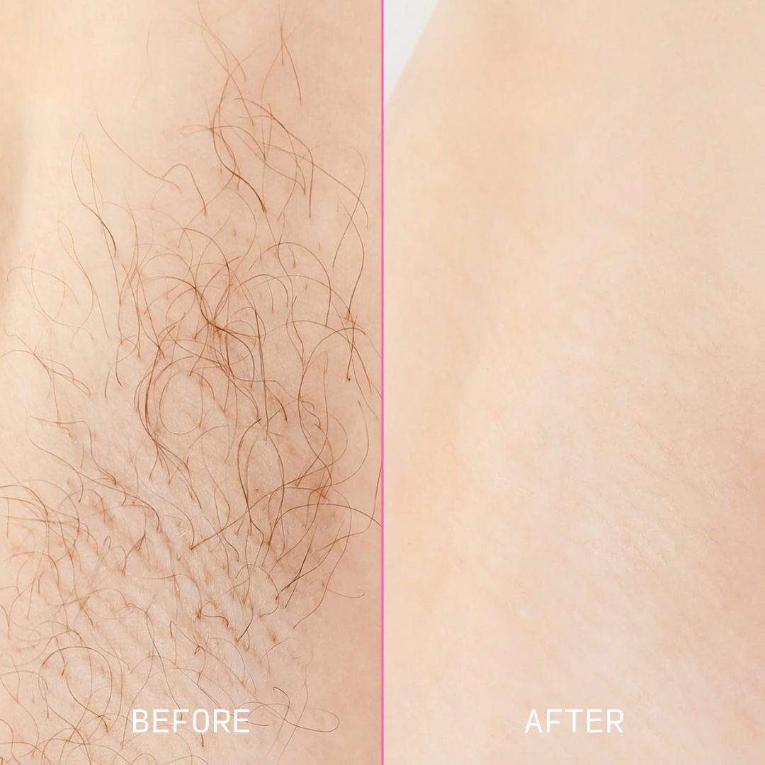 Before and after comparison of hair removal on a person