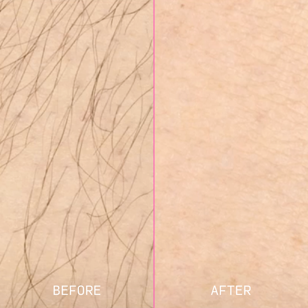 Before and after of Tria 4X Hair Removal Device