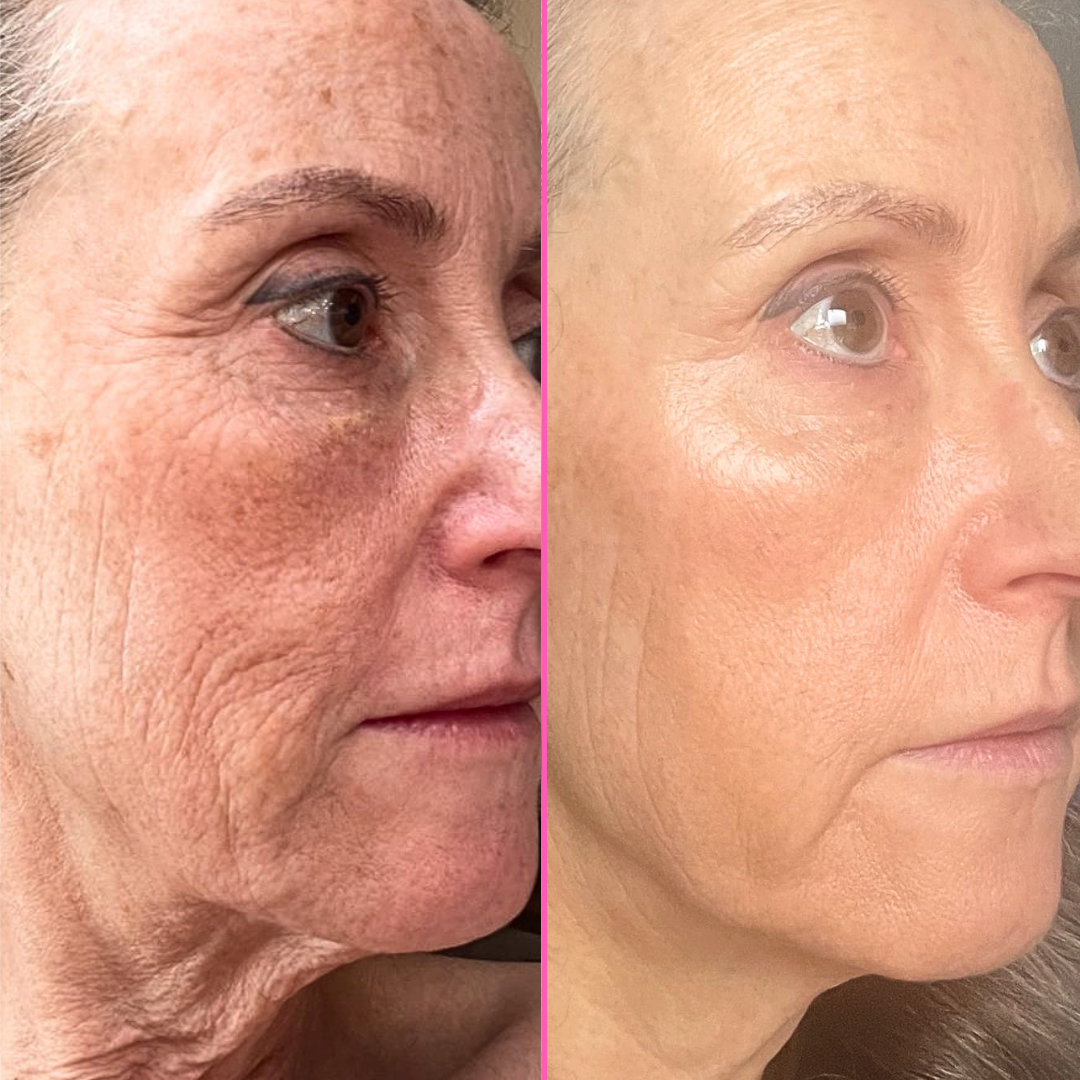 ✨【週末限定価格】Tria SKIN AGING CARE LASER At Home Face Laser | Facial Laser Skin Rejuvenation | Tria FRX